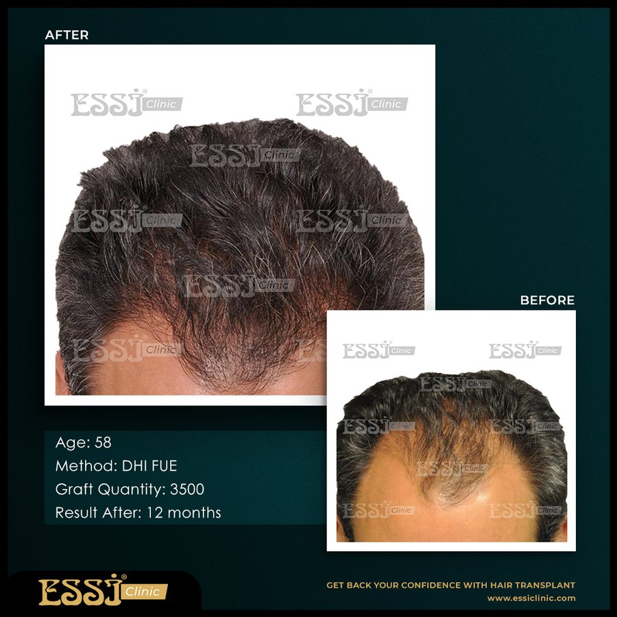 عيادة اسي لزراعة الشعر - Essi Hair Transplant Clinic