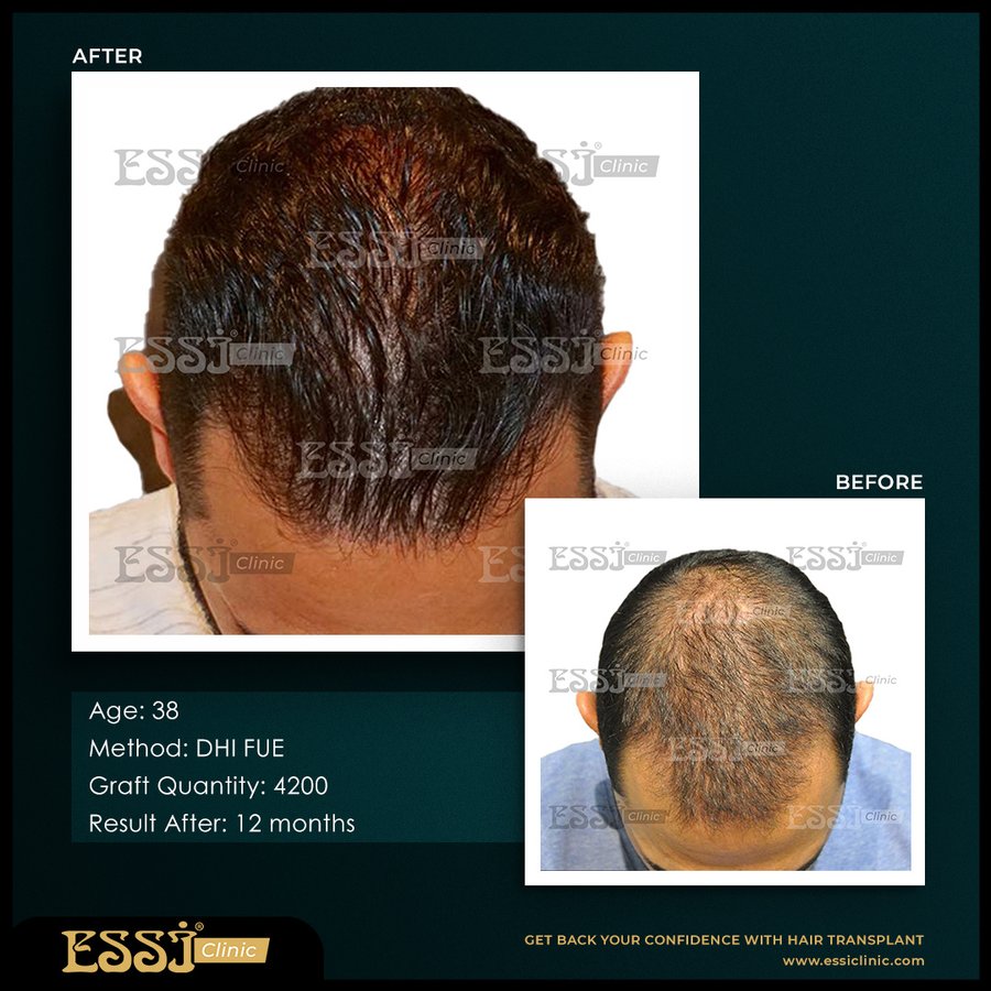 عيادة اسي لزراعة الشعر - Essi Hair Transplant Clinic