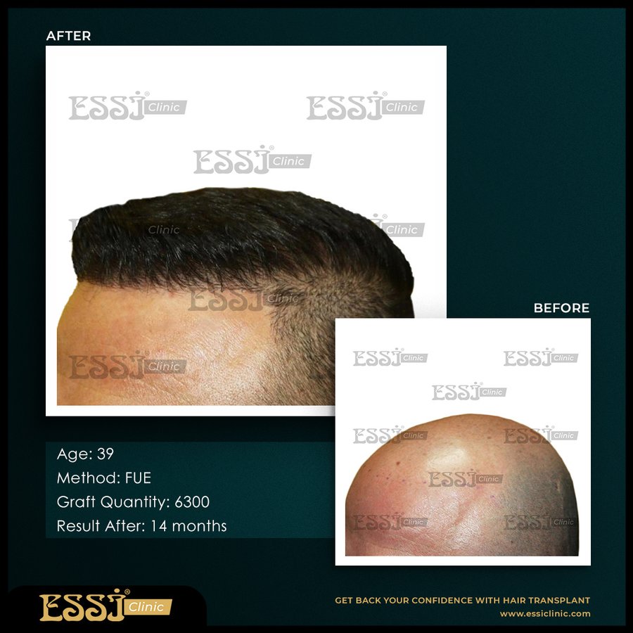 عيادة اسي لزراعة الشعر - Essi Hair Transplant Clinic