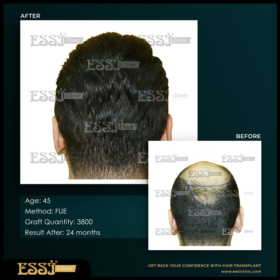 عيادة اسي لزراعة الشعر - Essi Hair Transplant Clinic