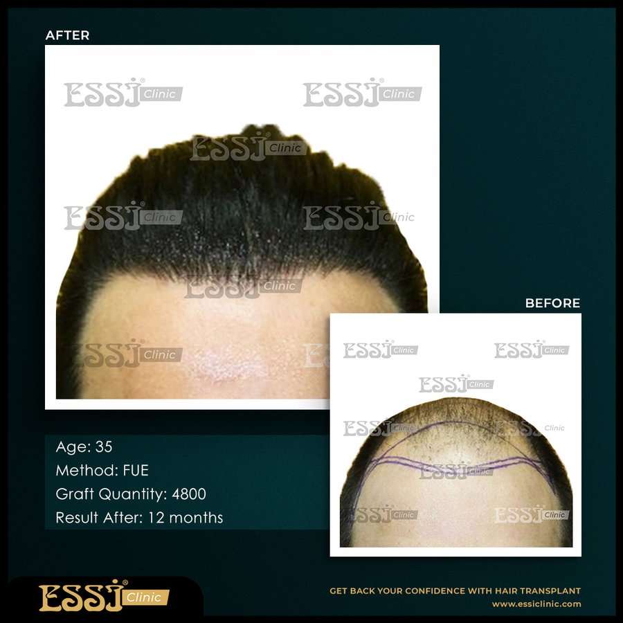 عيادة اسي لزراعة الشعر - Essi Hair Transplant Clinic