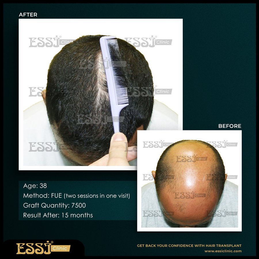 عيادة اسي لزراعة الشعر - Essi Hair Transplant Clinic