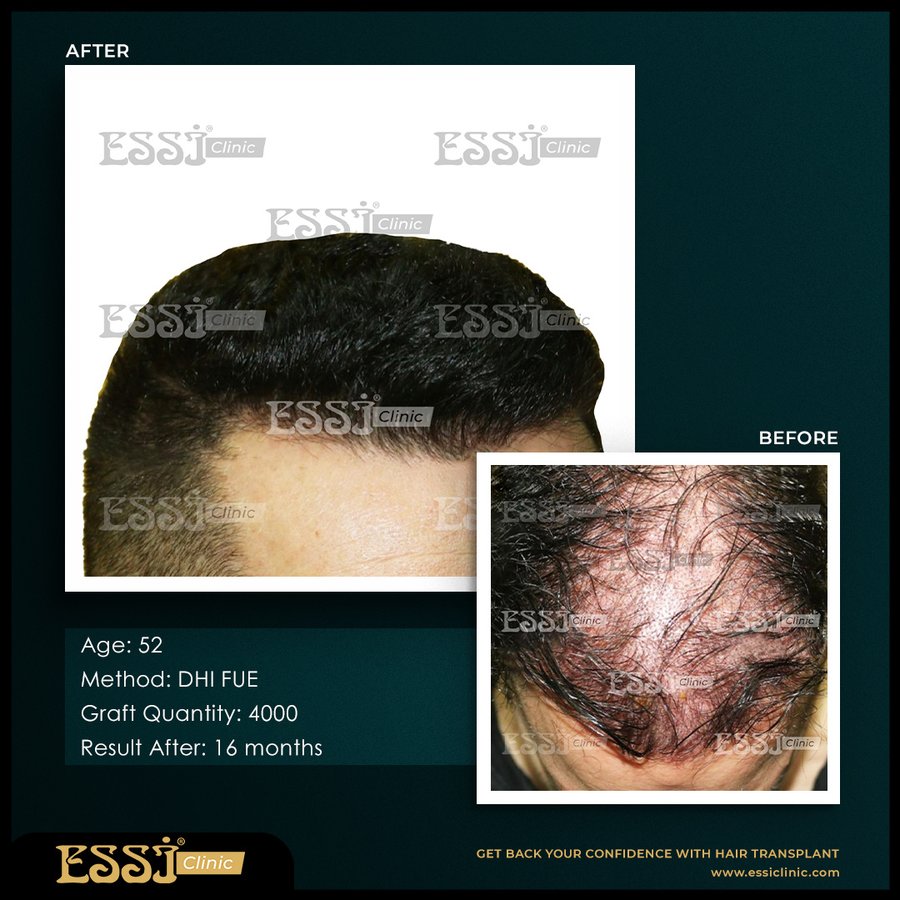 عيادة اسي لزراعة الشعر - Essi Hair Transplant Clinic