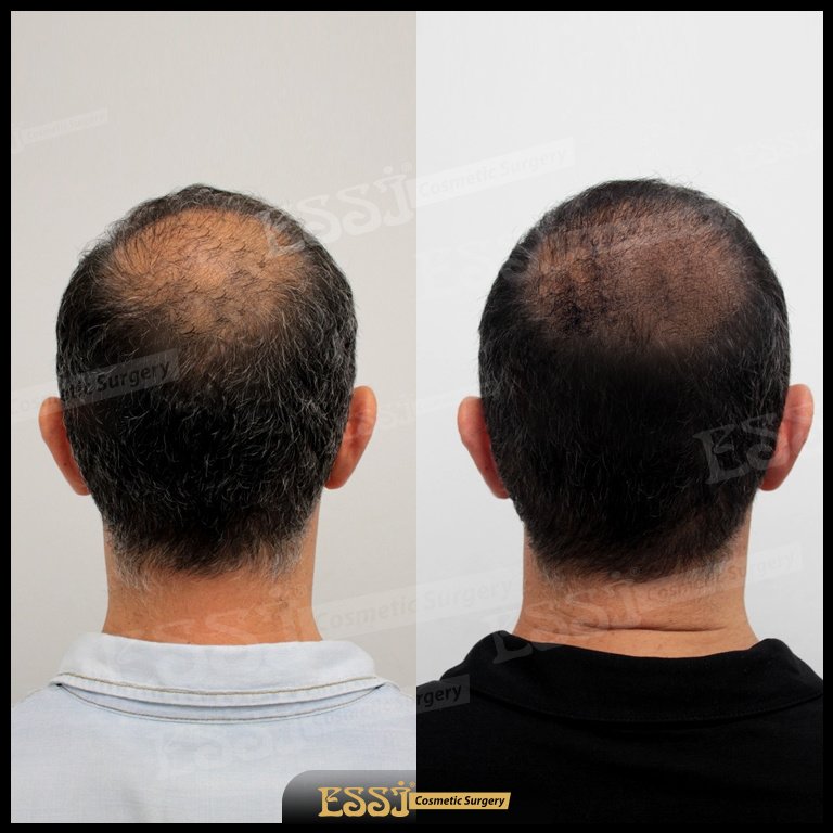 عيادة اسي لزراعة الشعر - Essi Hair Transplant Clinic