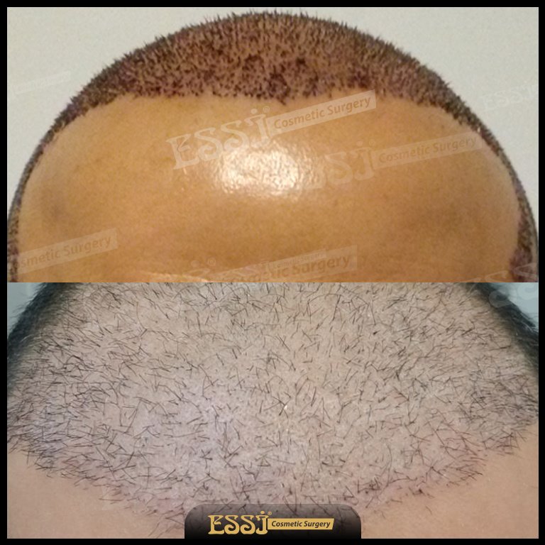 عيادة اسي لزراعة الشعر - Essi Hair Transplant Clinic