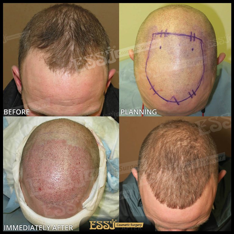 عيادة اسي لزراعة الشعر - Essi Hair Transplant Clinic