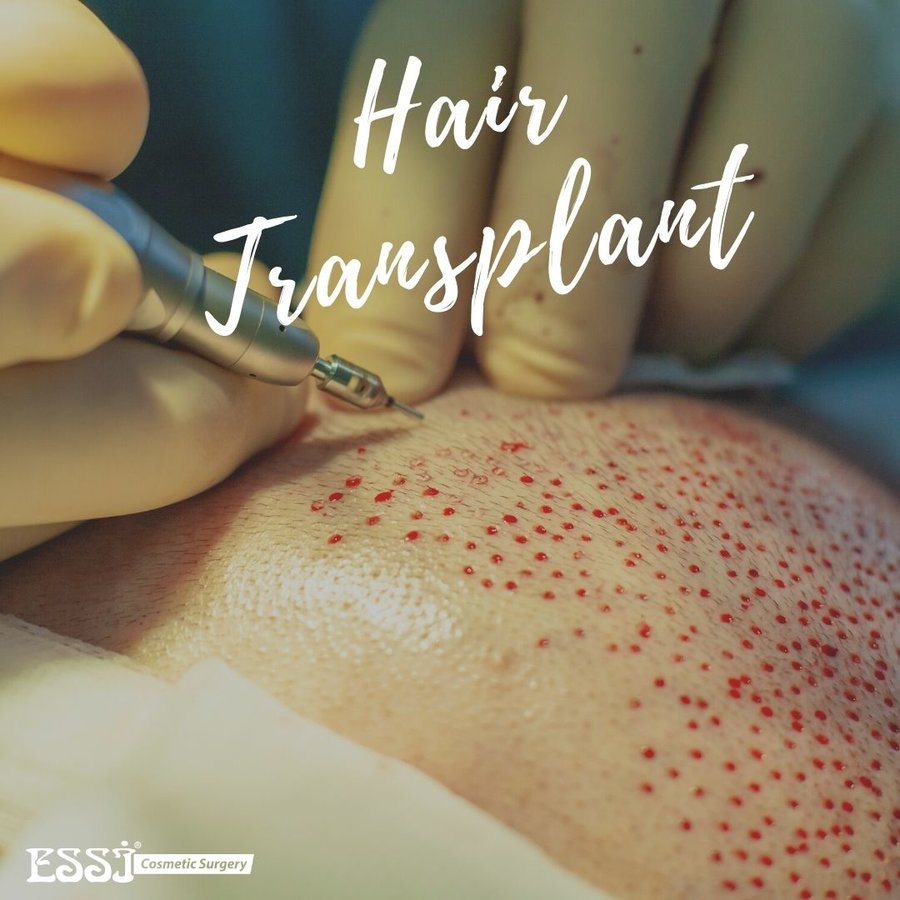 عيادة اسي لزراعة الشعر - Essi Hair Transplant Clinic