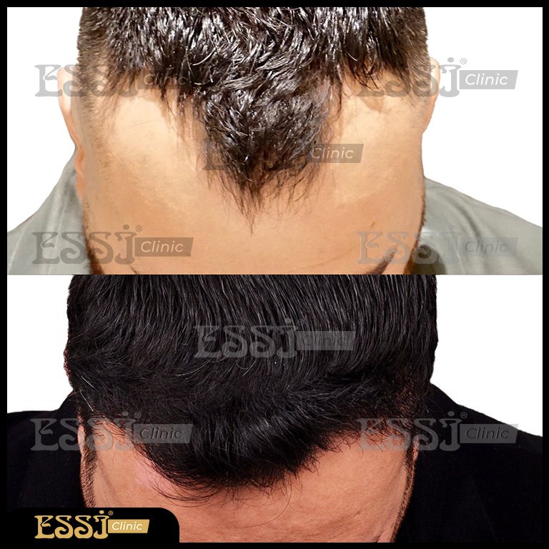 عيادة اسي لزراعة الشعر - Essi Hair Transplant Clinic