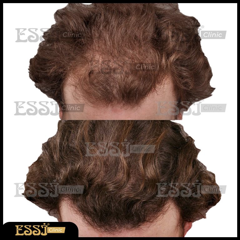 عيادة اسي لزراعة الشعر - Essi Hair Transplant Clinic