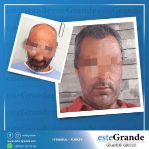 Este Grande Hair Transplant Turkey Istanbul - Este Grande Hair Transplant Turkey Istanbul