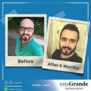 Este Grande Hair Transplant Turkey Istanbul - Este Grande Hair Transplant Turkey Istanbul