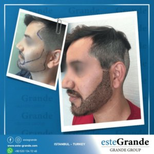 Este Grande Hair Transplant Turkey Istanbul - Este Grande Hair Transplant Turkey Istanbul