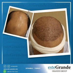 Este Grande Hair Transplant Turkey Istanbul - Este Grande Hair Transplant Turkey Istanbul