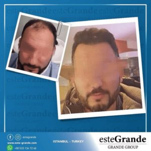 Este Grande Hair Transplant Turkey Istanbul - Este Grande Hair Transplant Turkey Istanbul