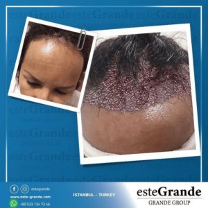 Este Grande Hair Transplant Turkey Istanbul - Este Grande Hair Transplant Turkey Istanbul