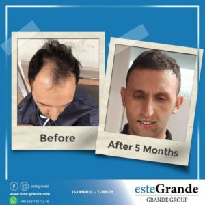 Este Grande Hair Transplant Turkey Istanbul - Este Grande Hair Transplant Turkey Istanbul