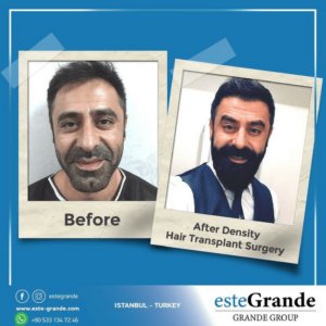 Este Grande Hair Transplant Turkey Istanbul - Este Grande Hair Transplant Turkey Istanbul
