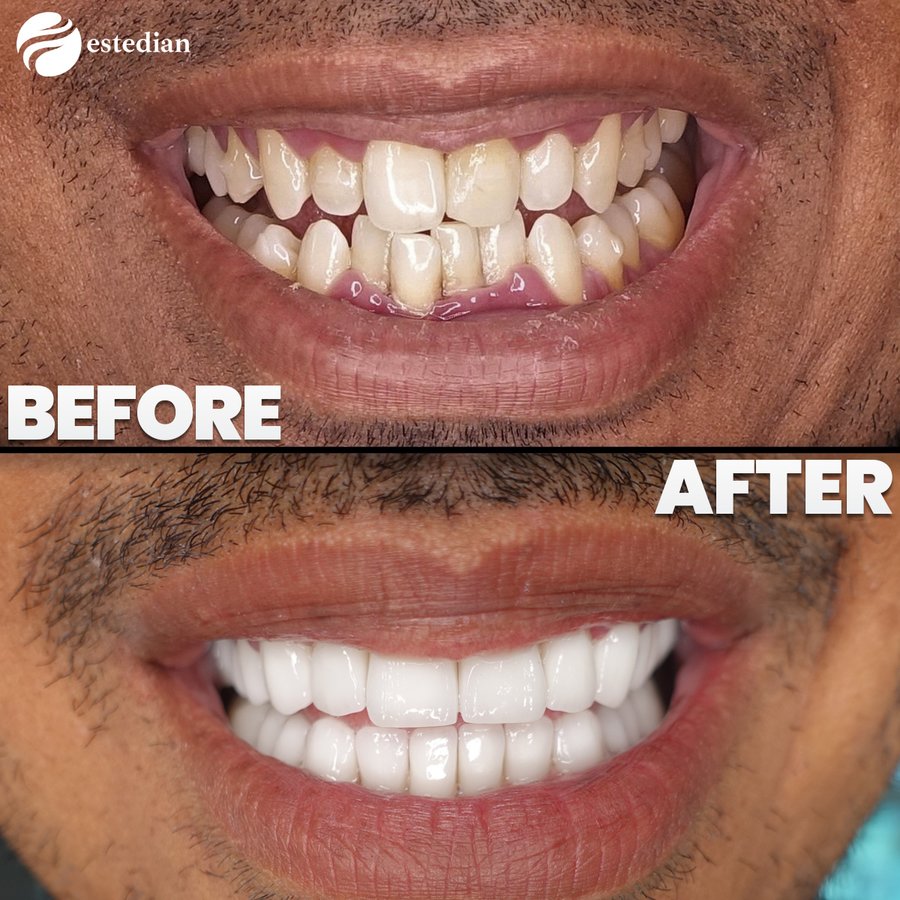 Estedian Dental - Antalya - Estedian Dental - Antalya