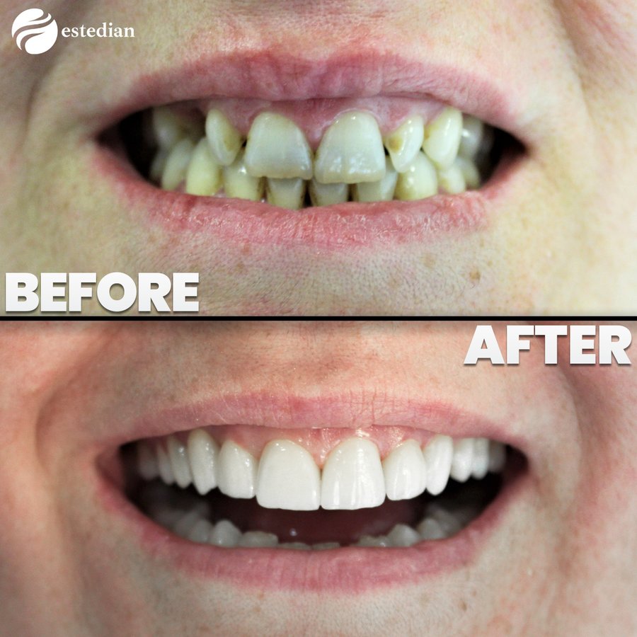 Estedian Dental - Antalya - Estedian Dental - Antalya