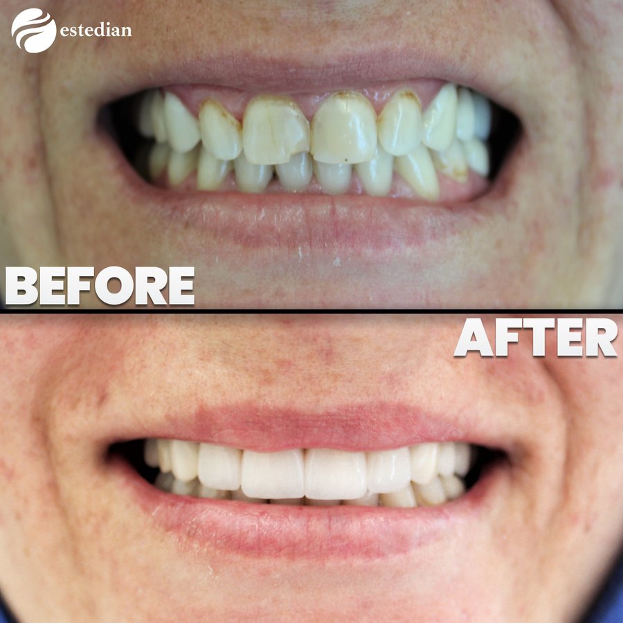 Estedian Dental - Antalya - Estedian Dental - Antalya