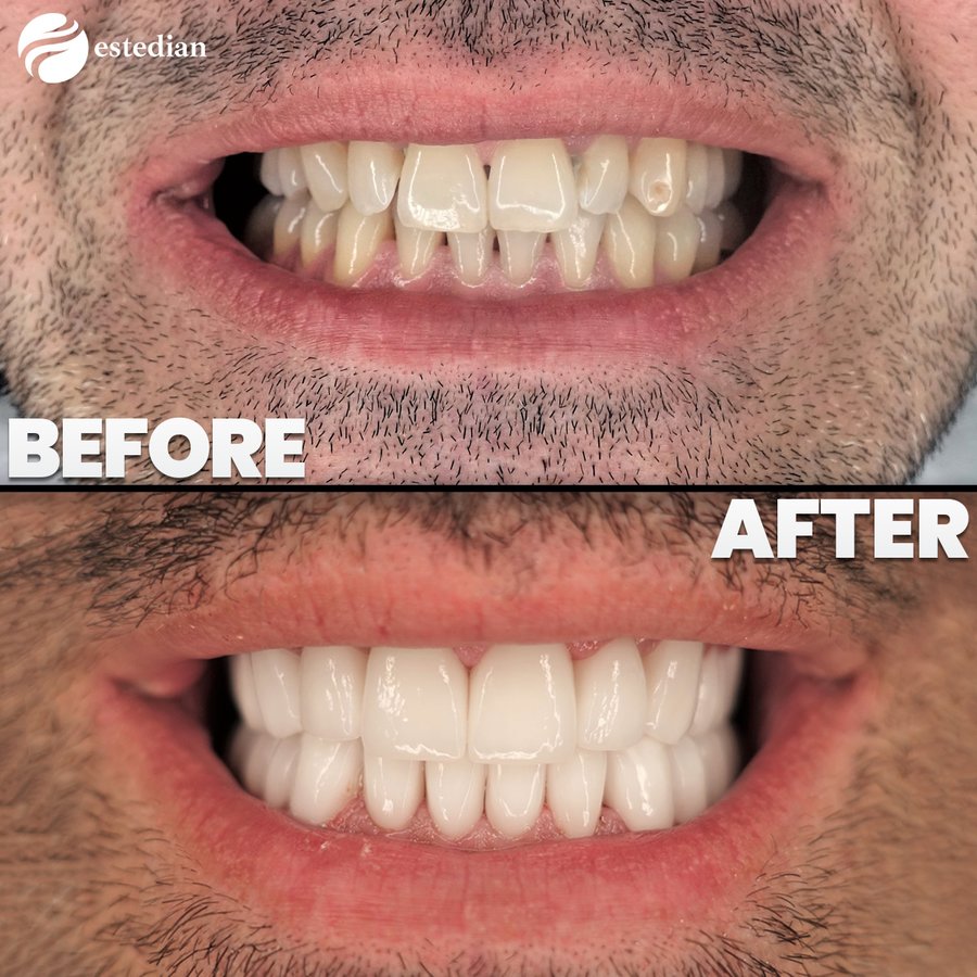 Estedian Dental - Antalya - Estedian Dental - Antalya