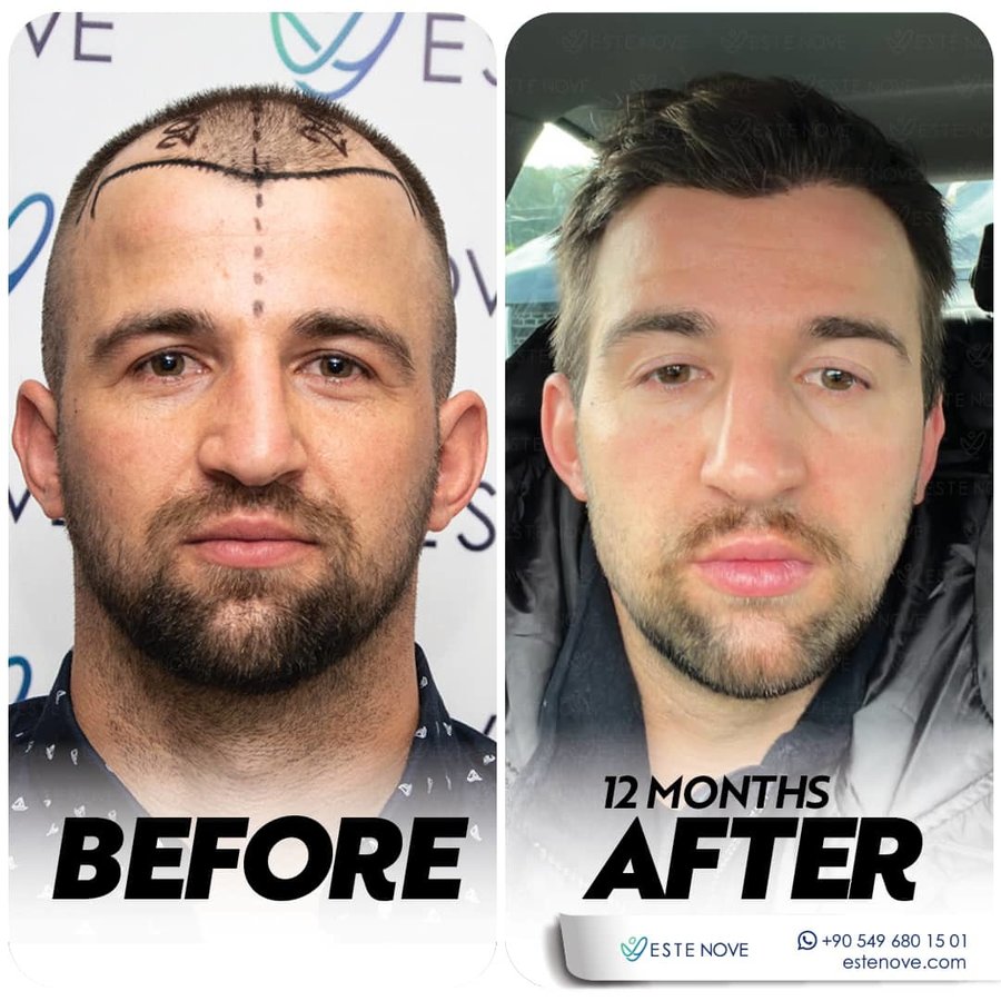 EsteNove Hair Transplant Clinic Turkey - EsteNove Hair Transplant Clinic Turkey