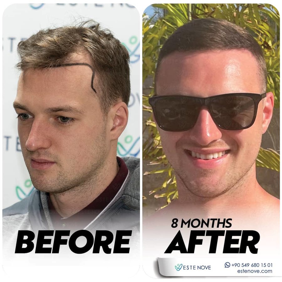 EsteNove Hair Transplant Clinic Turkey - EsteNove Hair Transplant Clinic Turkey