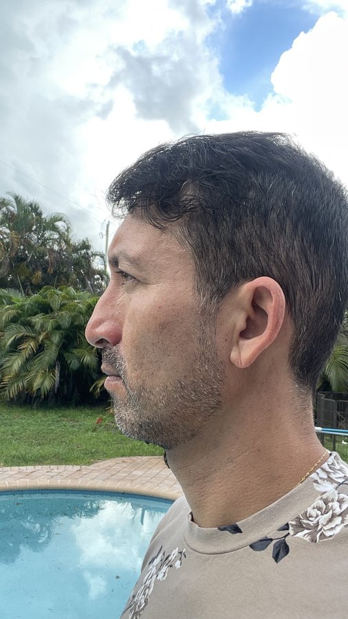 EsteNove Hair Transplant Clinic Turkey - EsteNove Hair Transplant Clinic Turkey