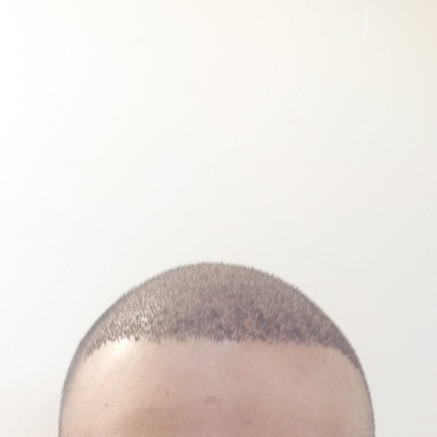 EsteNove Hair Transplant Clinic Turkey - EsteNove Hair Transplant Clinic Turkey