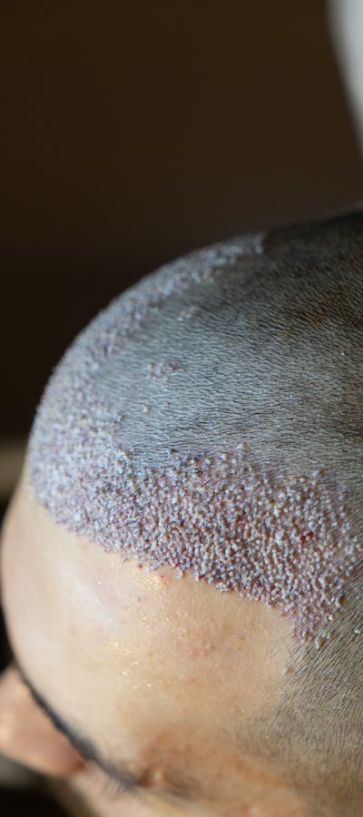 EsteNove Hair Transplant Clinic Turkey - EsteNove Hair Transplant Clinic Turkey