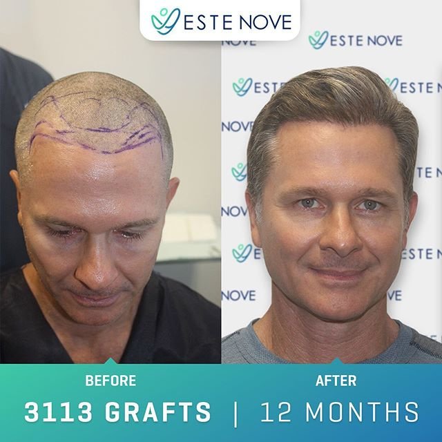 EsteNove Hair Transplant Clinic Turkey - EsteNove Hair Transplant Clinic Turkey