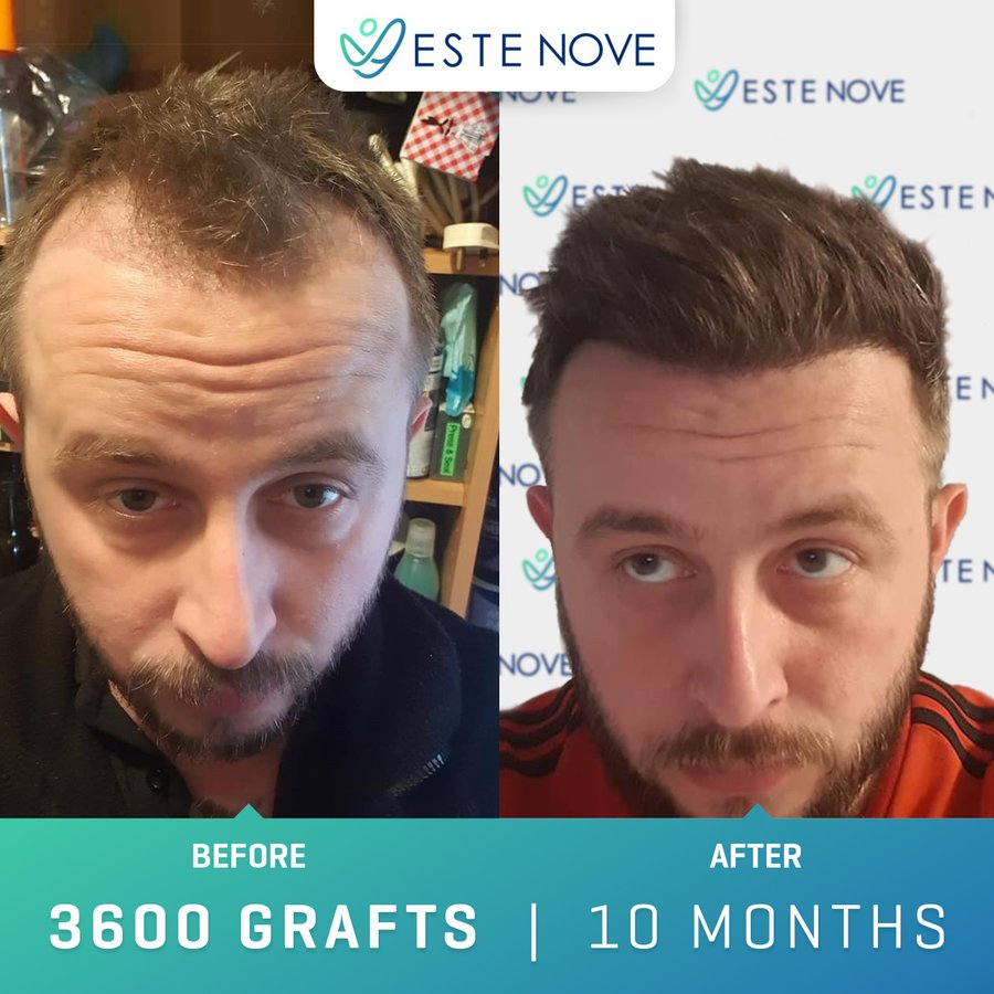 EsteNove Hair Transplant Clinic Turkey - EsteNove Hair Transplant Clinic Turkey