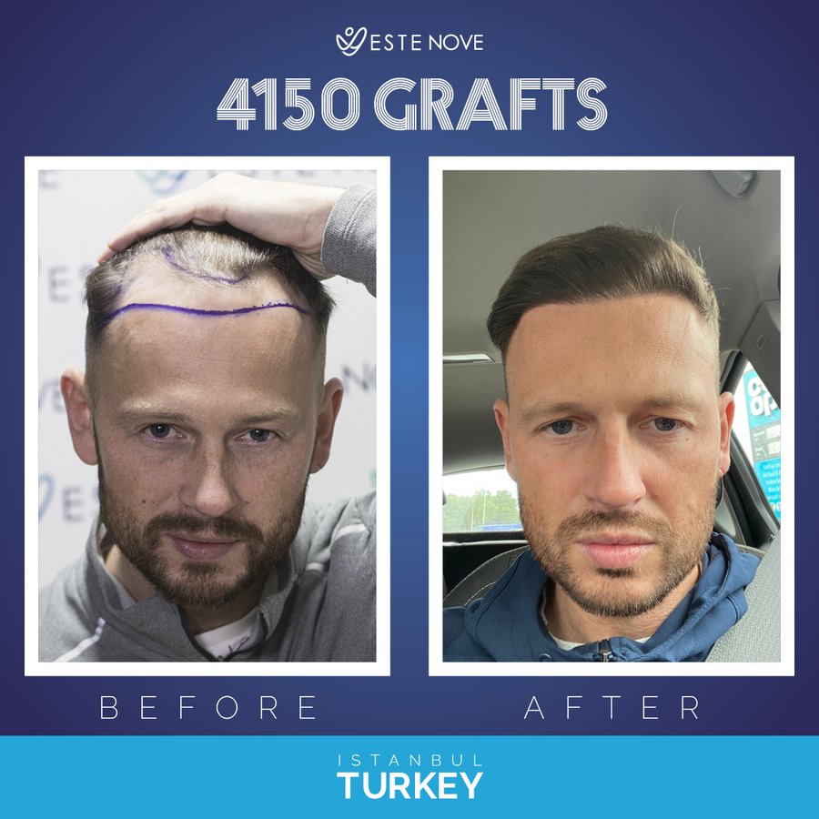 EsteNove Hair Transplant Clinic Turkey - EsteNove Hair Transplant Clinic Turkey