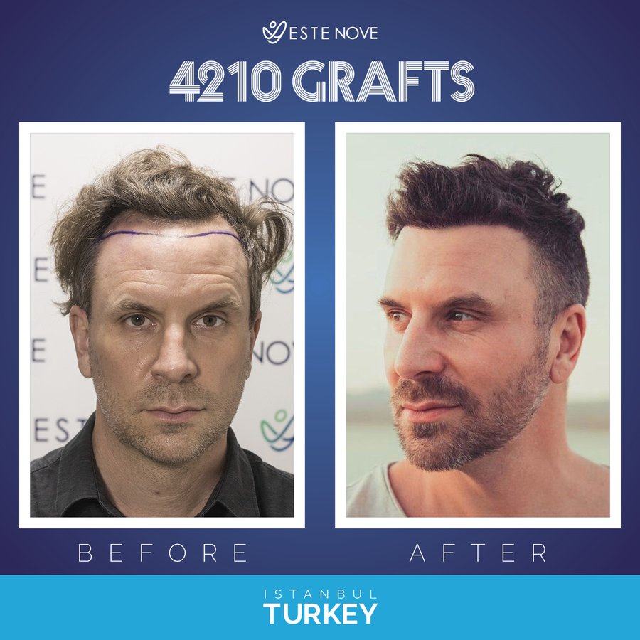EsteNove Hair Transplant Clinic Turkey - EsteNove Hair Transplant Clinic Turkey