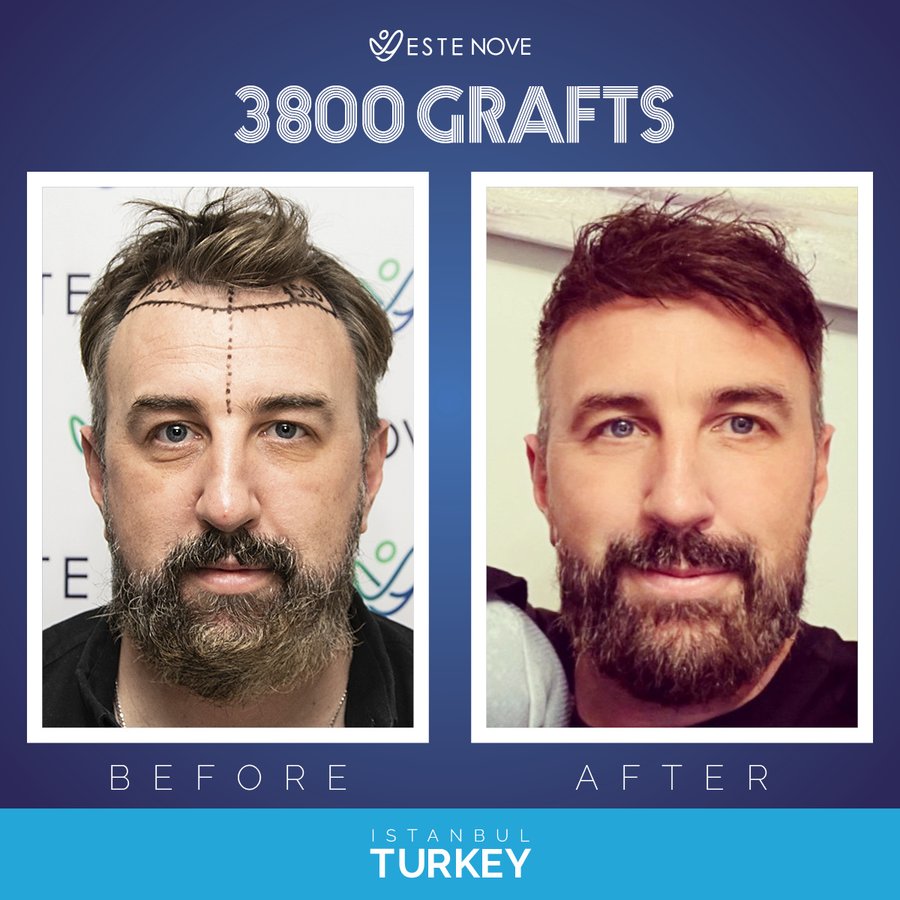 EsteNove Hair Transplant Clinic Turkey - EsteNove Hair Transplant Clinic Turkey
