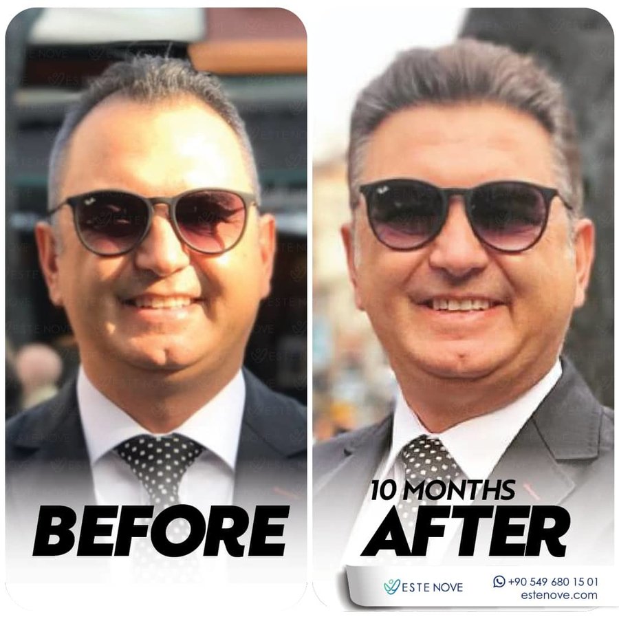 EsteNove Hair Transplant Clinic Turkey - EsteNove Hair Transplant Clinic Turkey