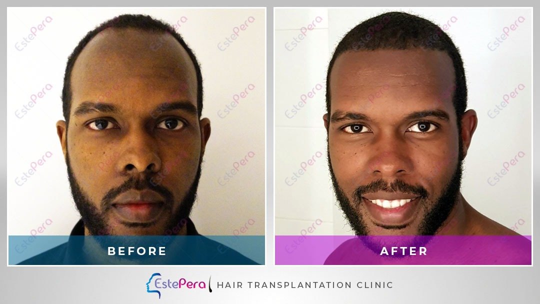EstePera Hair Transplant Turkey - EstePera Hair Transplant Turkey