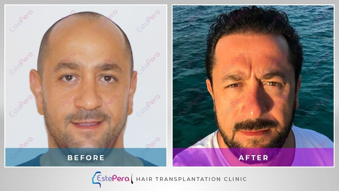 EstePera Hair Transplant Turkey - EstePera Hair Transplant Turkey