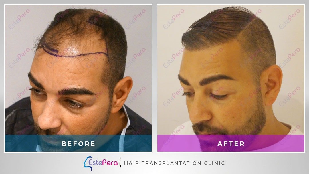 EstePera Hair Transplant Turkey - EstePera Hair Transplant Turkey
