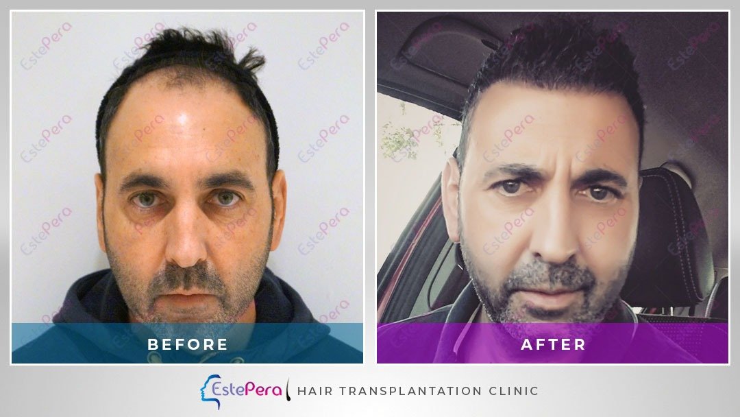 EstePera Hair Transplant Turkey - EstePera Hair Transplant Turkey