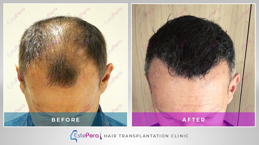 EstePera Hair Transplant Turkey - EstePera Hair Transplant Turkey