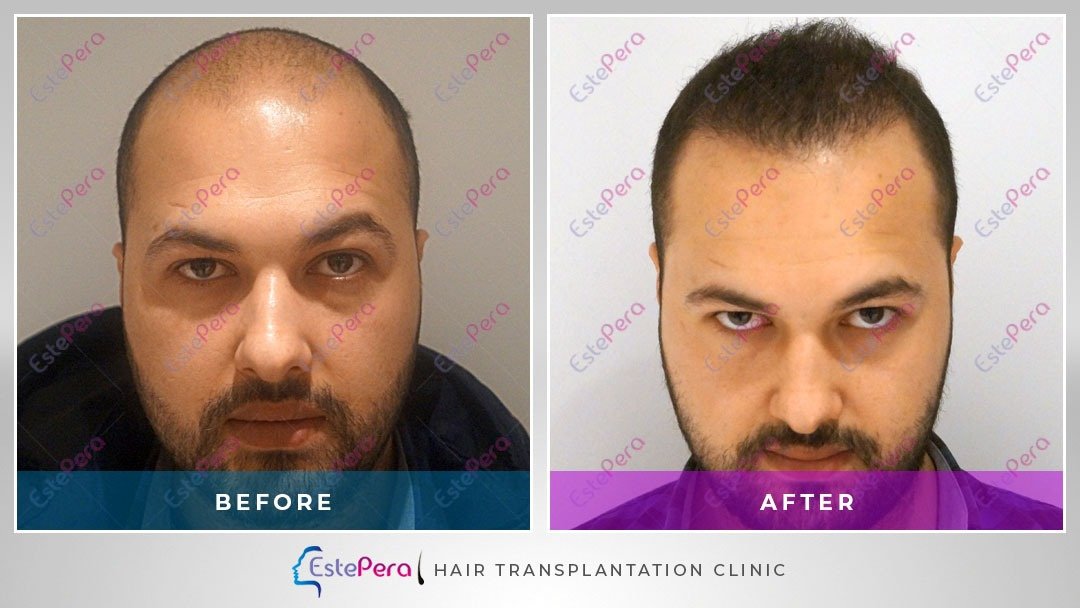 EstePera Hair Transplant Turkey - EstePera Hair Transplant Turkey