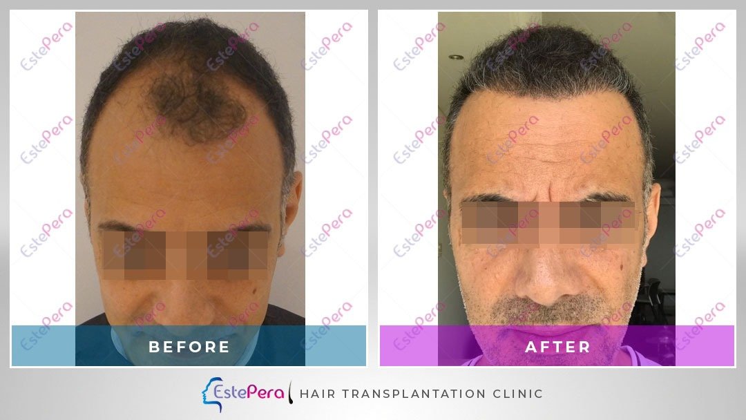 EstePera Hair Transplant Turkey - EstePera Hair Transplant Turkey