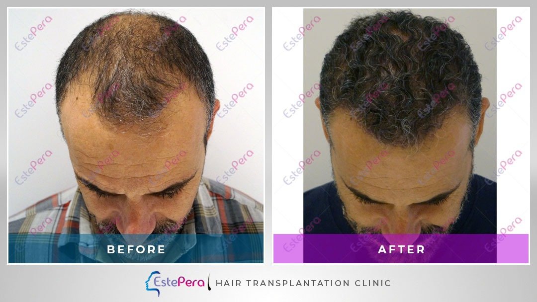 EstePera Hair Transplant Turkey - EstePera Hair Transplant Turkey