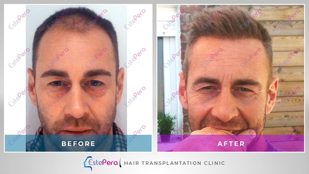 EstePera Hair Transplant Turkey - EstePera Hair Transplant Turkey