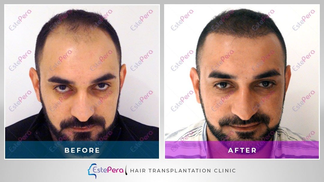 EstePera Hair Transplant Turkey - EstePera Hair Transplant Turkey