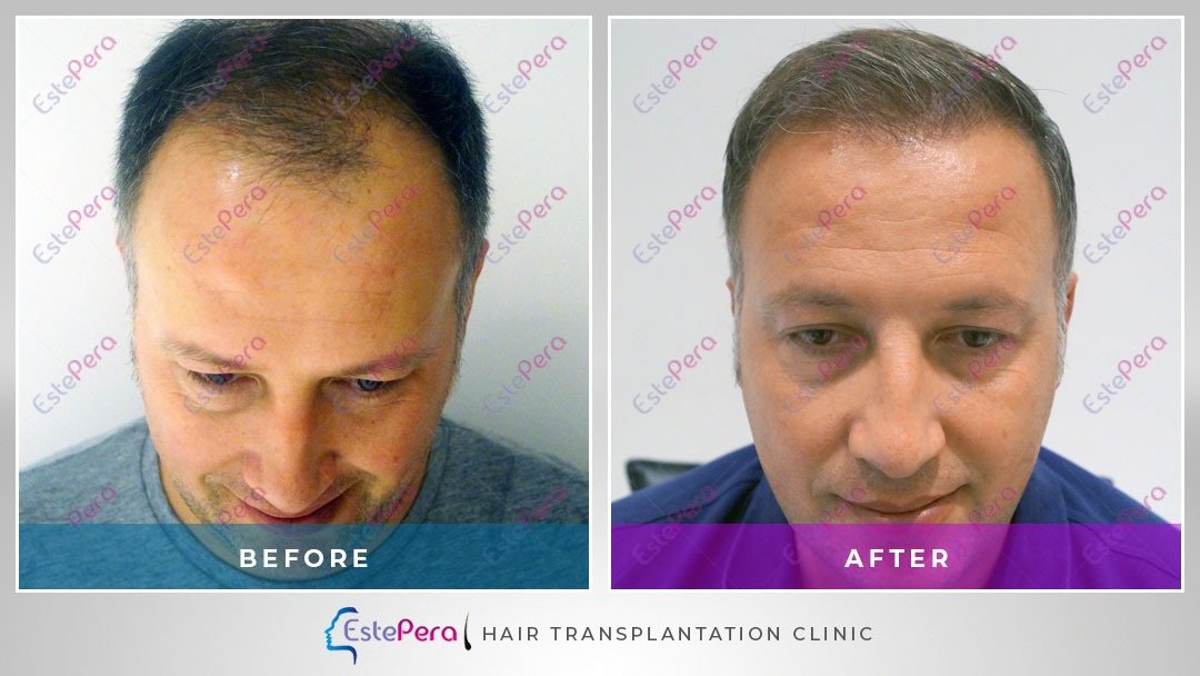 EstePera Hair Transplant Turkey - EstePera Hair Transplant Turkey