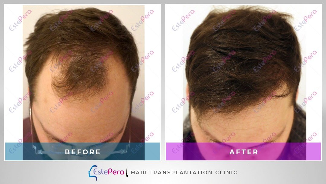 EstePera Hair Transplant Turkey - EstePera Hair Transplant Turkey