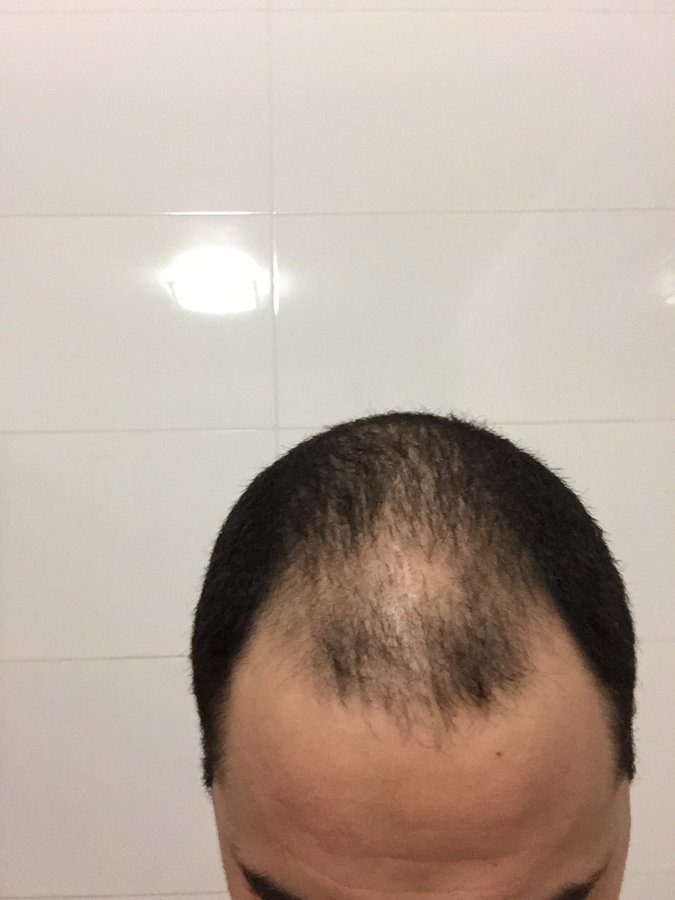 EstePera Hair Transplant Turkey - EstePera Hair Transplant Turkey