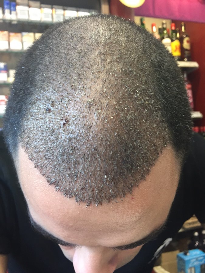 EstePera Hair Transplant Turkey - EstePera Hair Transplant Turkey